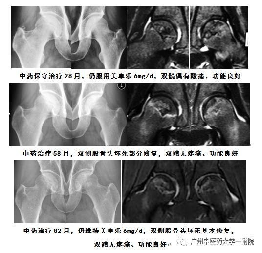 最新股骨頭壞死療法，為患者帶來希望之光的新征程